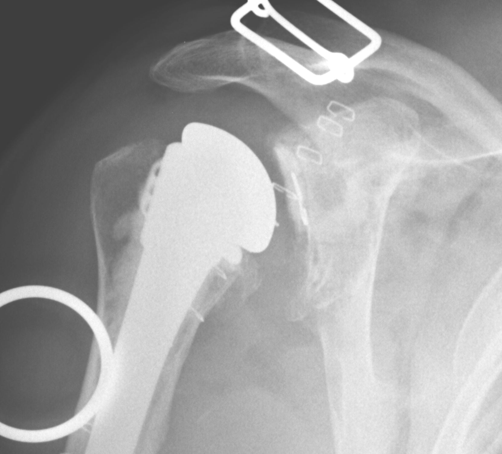 Revision TSR Loose Glenoid